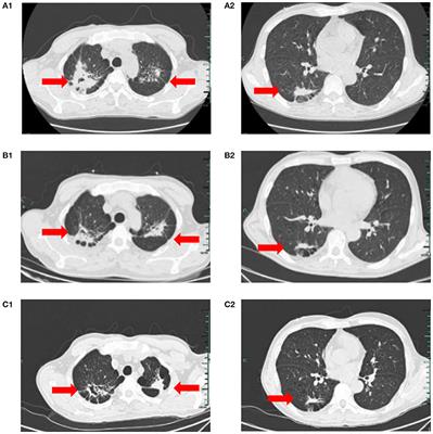 A case report of complete remission of acute myeloid leukemia combined with DNMT3A, FLT3-TKD, and IDH2 gene mutations and active pulmonary tuberculosis treated with homeharringtonine + venetoclax + azacytidine